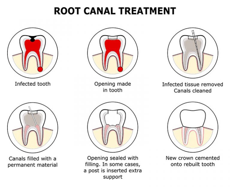 Root Canal Therapy in Las Vegas, NV Micro Endodontics of Las Vegas